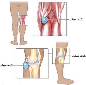 Why does anyone come to us behind the knee?