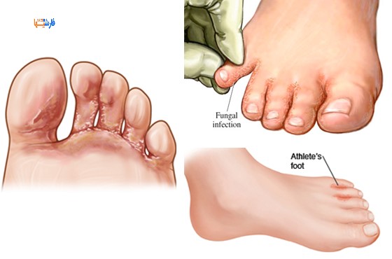 درمان خانگی قارچ