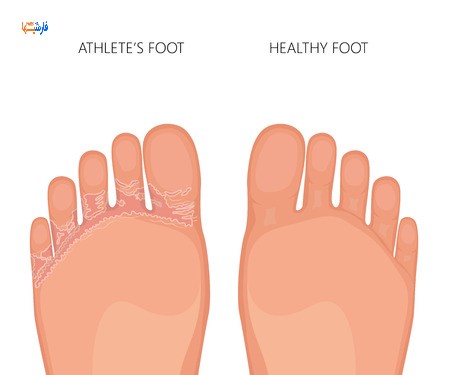 درمان قارچ پا