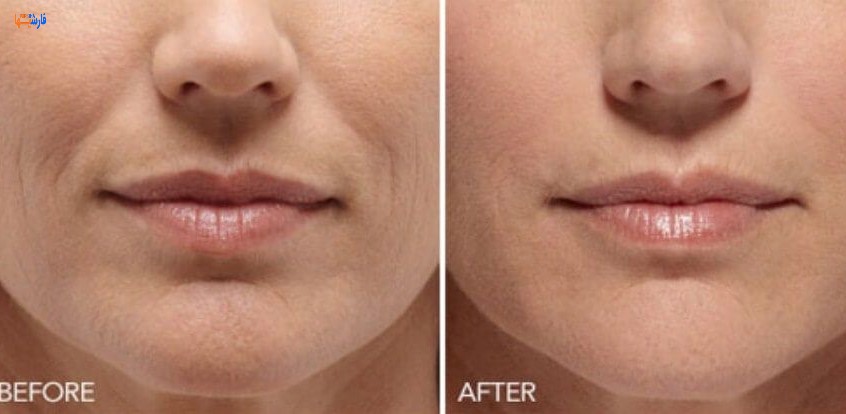 روش طبیعی برای از بین بردن خط لبخند