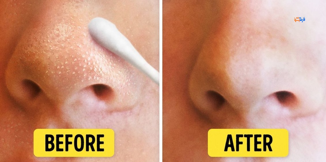 درمان های خانگی برای جوش های سر سفید