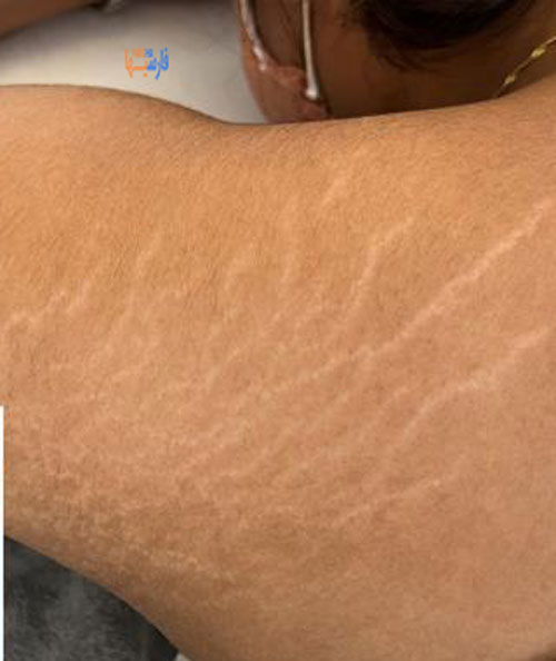 ترک‌های پوستی چرا اتفاق می‌افتند؟