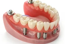 اوردنچر دندان