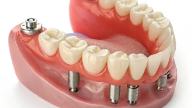 اوردنچر دندان