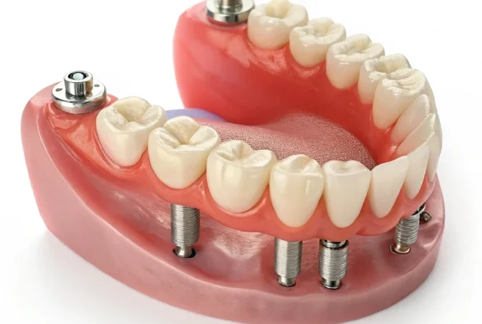 اوردنچر دندان