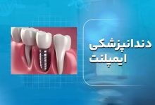 دندانپزشکی ایمپلنت